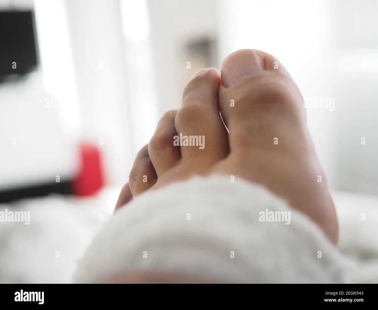 Geschwollene und gequetscht Zehen aus der Nähe Stockfoto