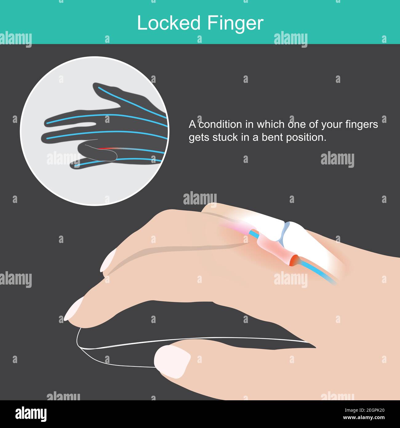 Gesperrter Finger. Dieses Bild zeigt den Menschen von Hand und Probe, die verursacht werden, von denen einer Ihrer Finger in einer verbogenen Position feststeckt, die oft als verriegelte Fi bezeichnet wird Stock Vektor
