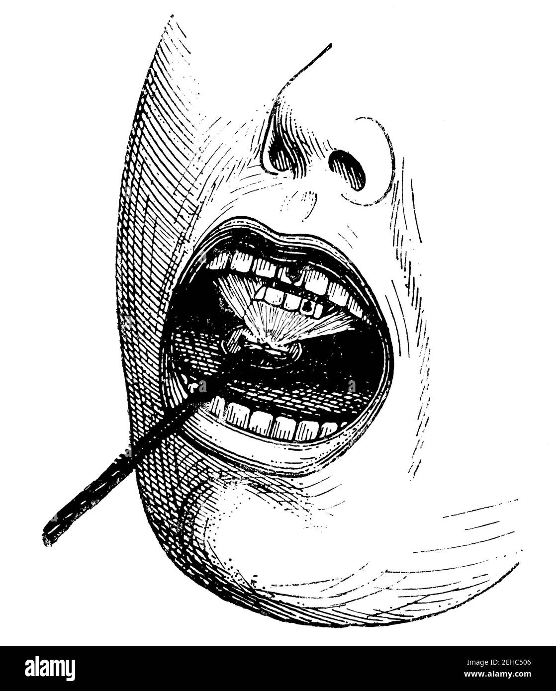 Beleuchtung der Mundhöhle durch elektrisches Licht. Illustration des 19th. Jahrhunderts. Deutschland. Weißer Hintergrund. Stockfoto