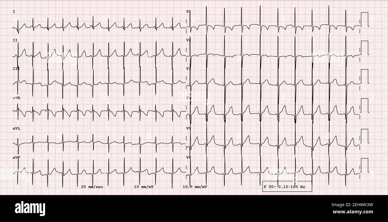 EKG-Beispiel für einen normalen 12-Kanal-Sinusrhythmus bei Kindern Patient Stockfoto