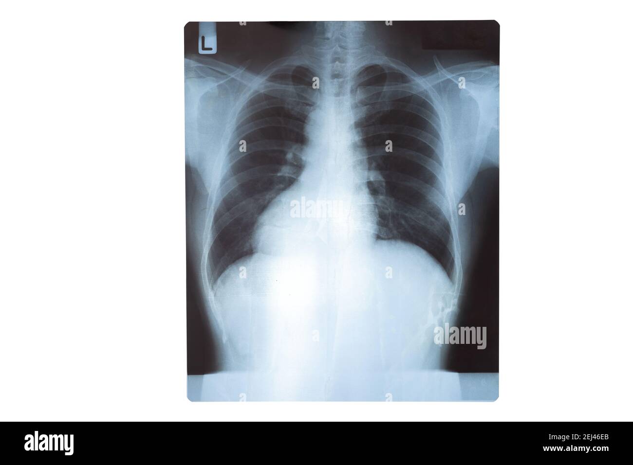 Ein Röntgenfilm eines Patienten. Medizinische Ausbildung. Anormale Röntgenstrahlung bei Lungeninfektionen. Covid 19 Pneumonie. Stockfoto