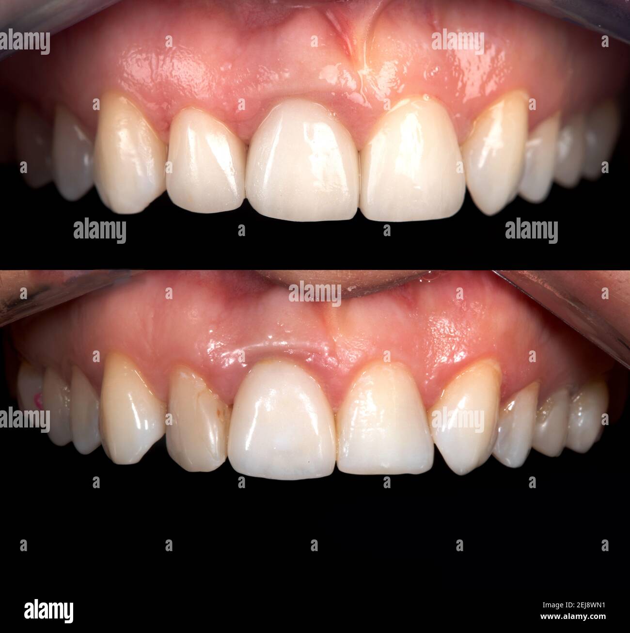 Perfektes Lächeln vor und nach Bleaching Verfahren Bleaching von Zirkonbogen keramische Prothesen Implantate Kronen. Zahnärztliche Restaurierung Behandlung Klinik Pat Stockfoto