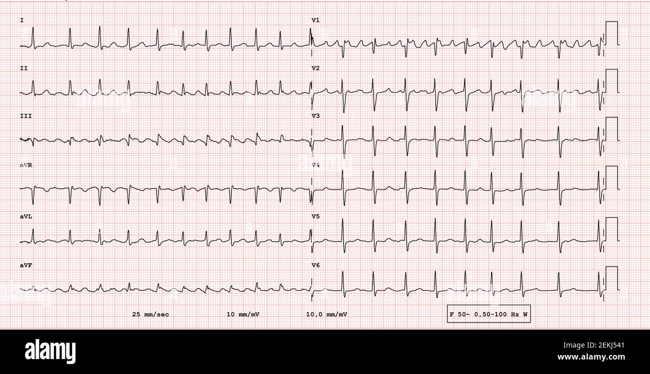 EKG-Beispiel für einen pathologischen 12-Kanal-Rhythmus, Vorhofflattern Stockfoto