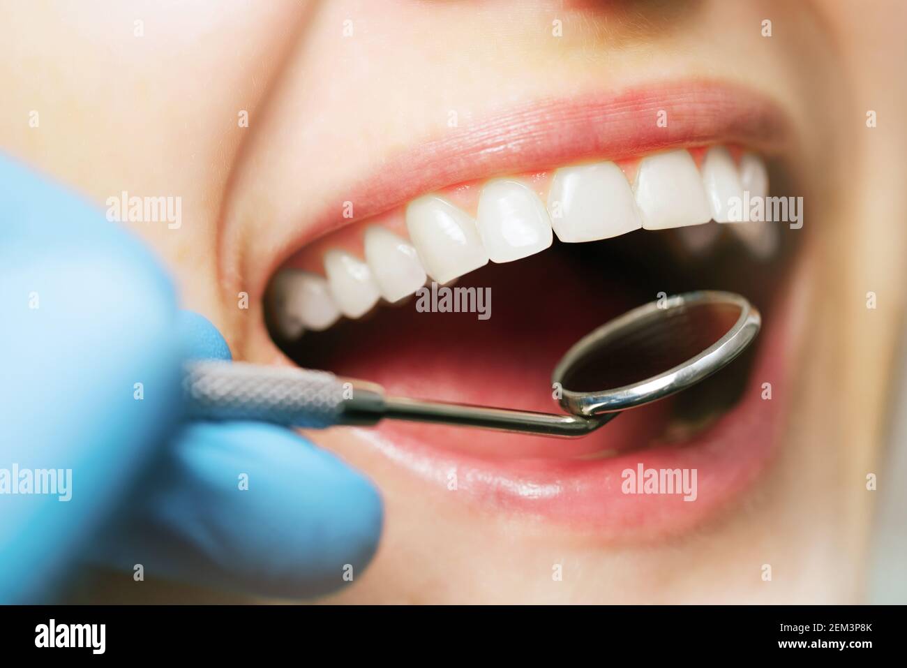 Munduntersuchung Mundhygiene. Weiße gesunde Frau Zähne und Zahnarzt Spiegel. Nahaufnahme Stockfoto