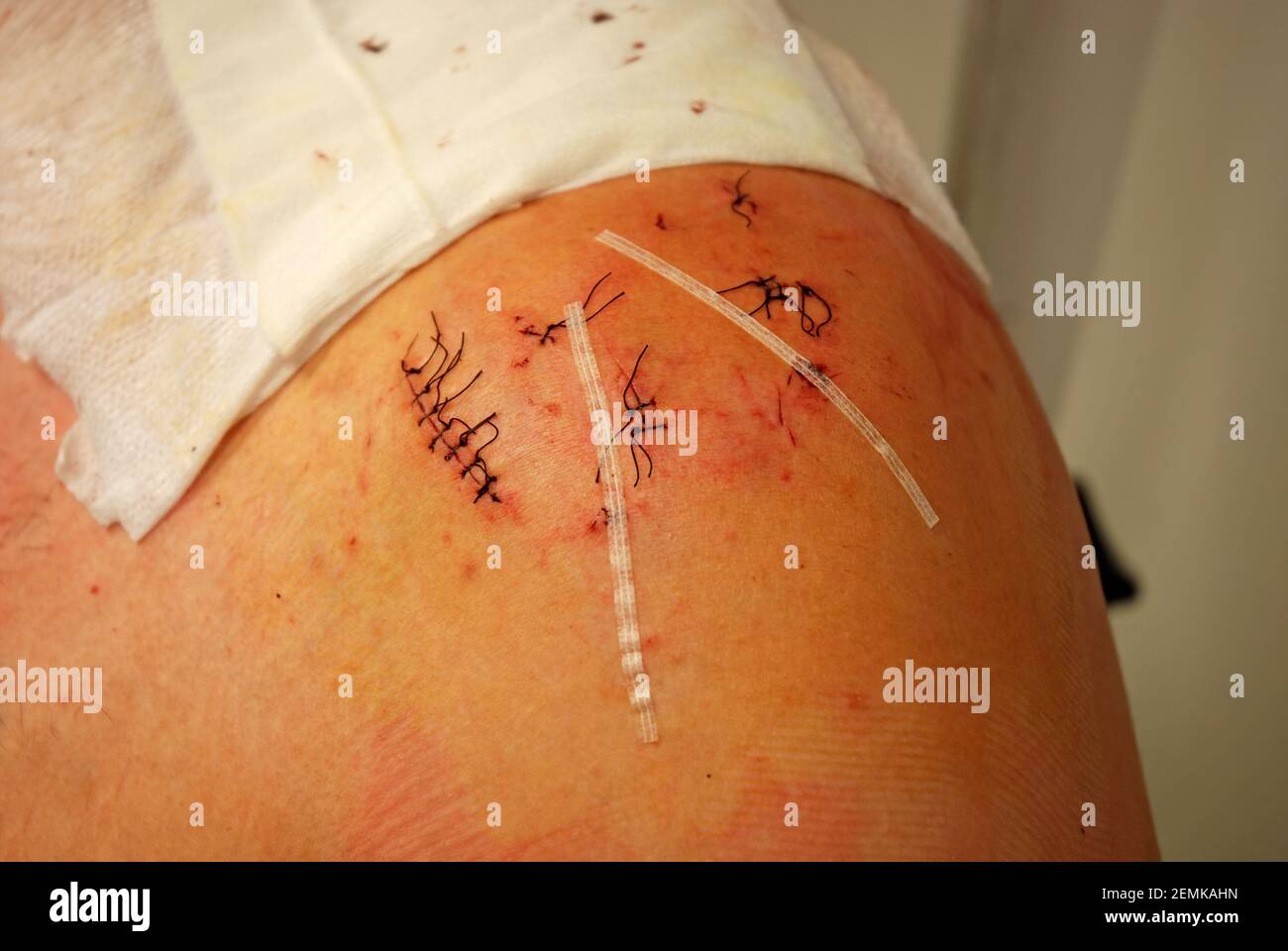 Eine Person zeigt die Stiche nach einer Schulteroperation und einem sterilen Mullverband. Stockfoto