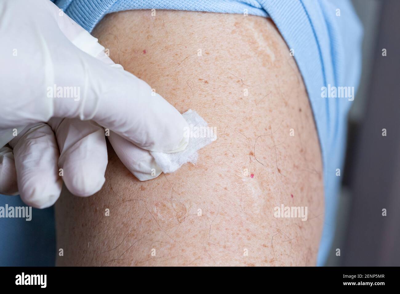 Der Arzt wischt die Haut vor der Impfung oder Injektion mit einer in  Alkohol getränkten Serviette ab. Desinfektion der Injektionsstelle  Stockfotografie - Alamy