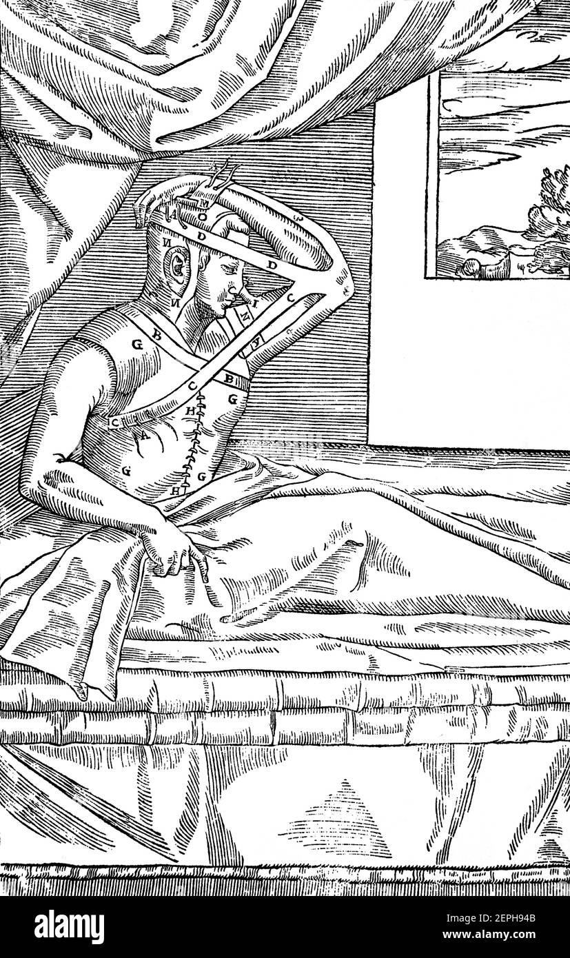 Eine Illustration der Nasal-Rekonstruktion aus dem 16th. Jahrhundert, wie sie von Gaspare Tagliacozzi (1545-1599), einem italienischen Chirurgen, Pionier der plastischen und rekonstruktiven Chirurgie, praktiziert wird. Diese Operation für die Nasal-Rekonstruktion (Rhinoplastik) wurde in Italien aufgrund der Popularität des Duellierens mit Rapier im fünfzehnten, sechzehnten und siebzehnten Jahrhundert entwickelt. Stockfoto