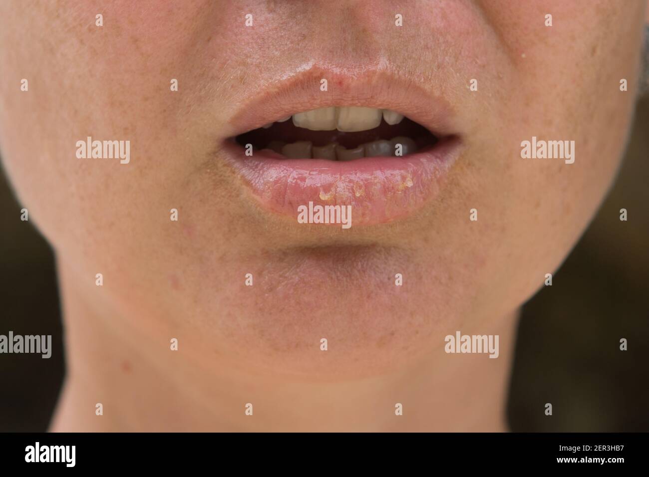 In der Nähe der weiblichen Lippen Herpes Krankheit leiden. Stockfoto