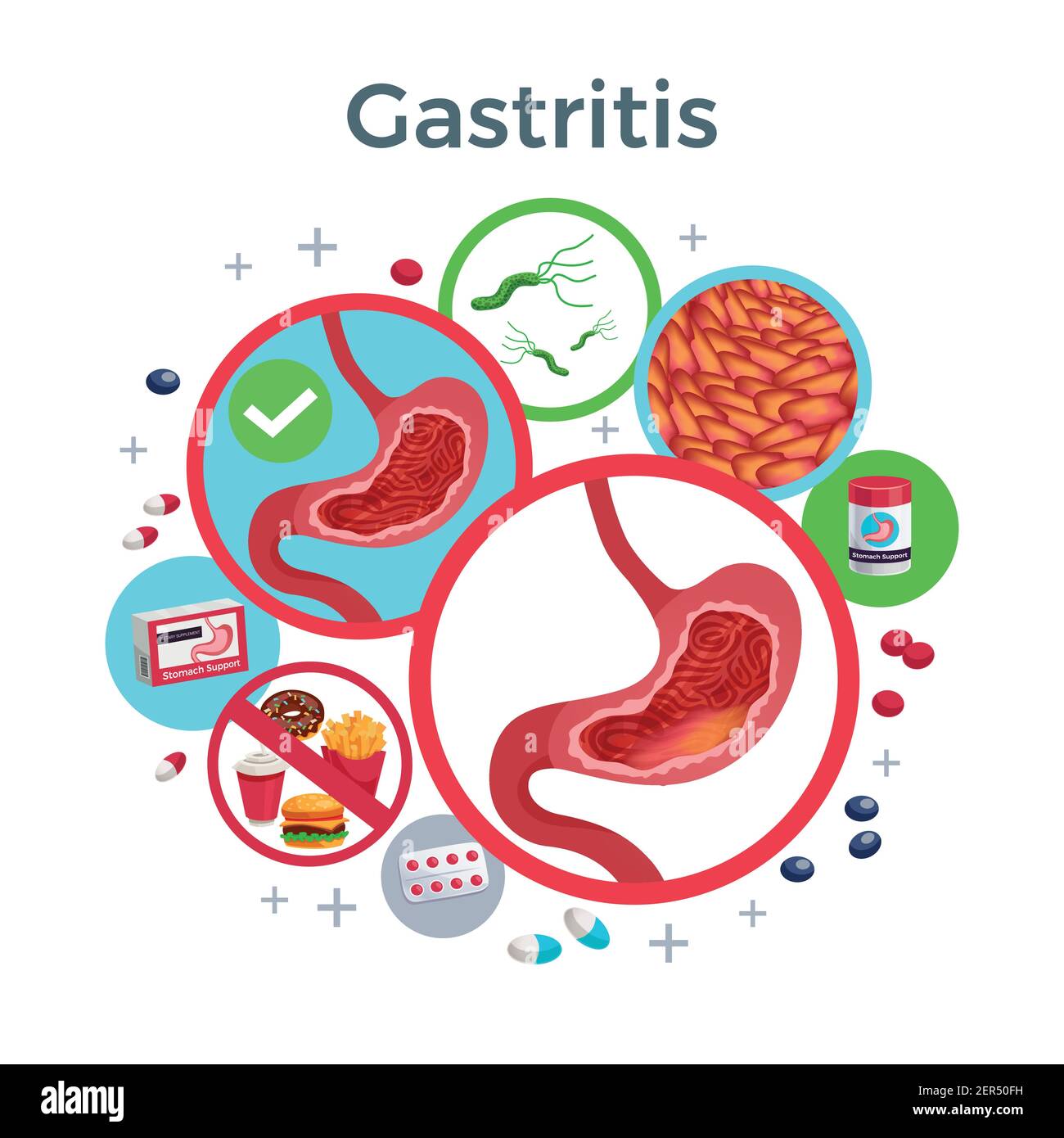 Gastritis Krankheit Symptome verursacht Medizin flache kreisförmige Zusammensetzung der gesunden Und betroffenen Magen Bakterien Lebensmittel Vektor Illustration Stock Vektor