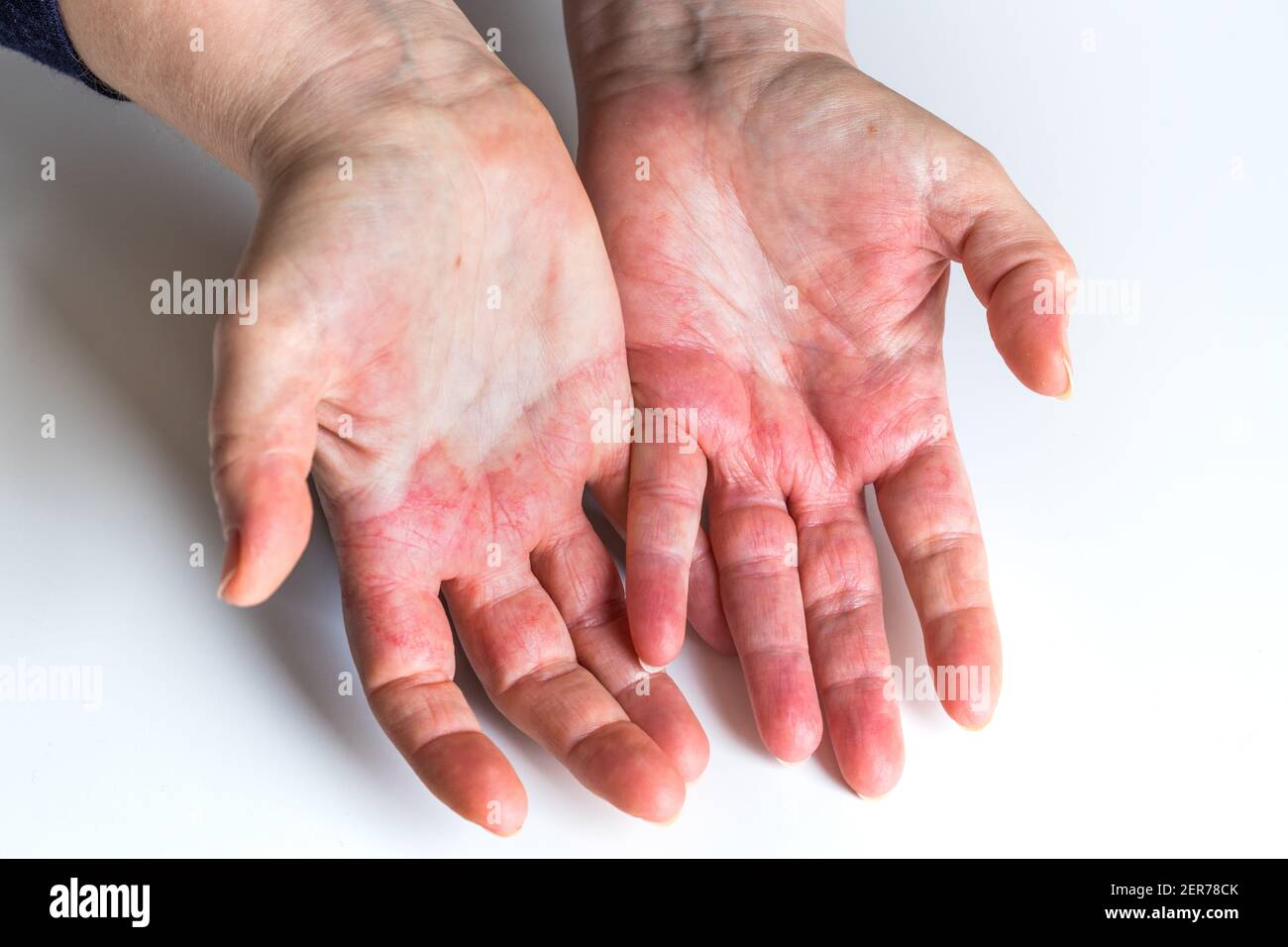 Atopische Dermatitis, rot, juckende Hände mit Blasen und rissige Haut  Stockfotografie - Alamy