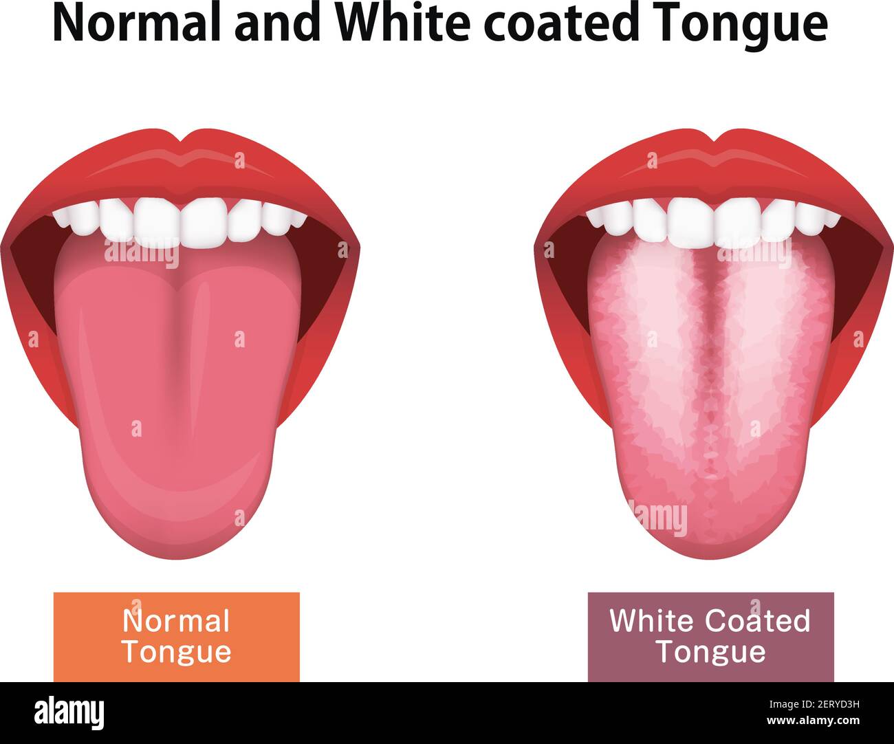 Zunge Gesundheit Zeichen Vektor-Illustration ( weiß beschichtete Zunge ) Stock Vektor