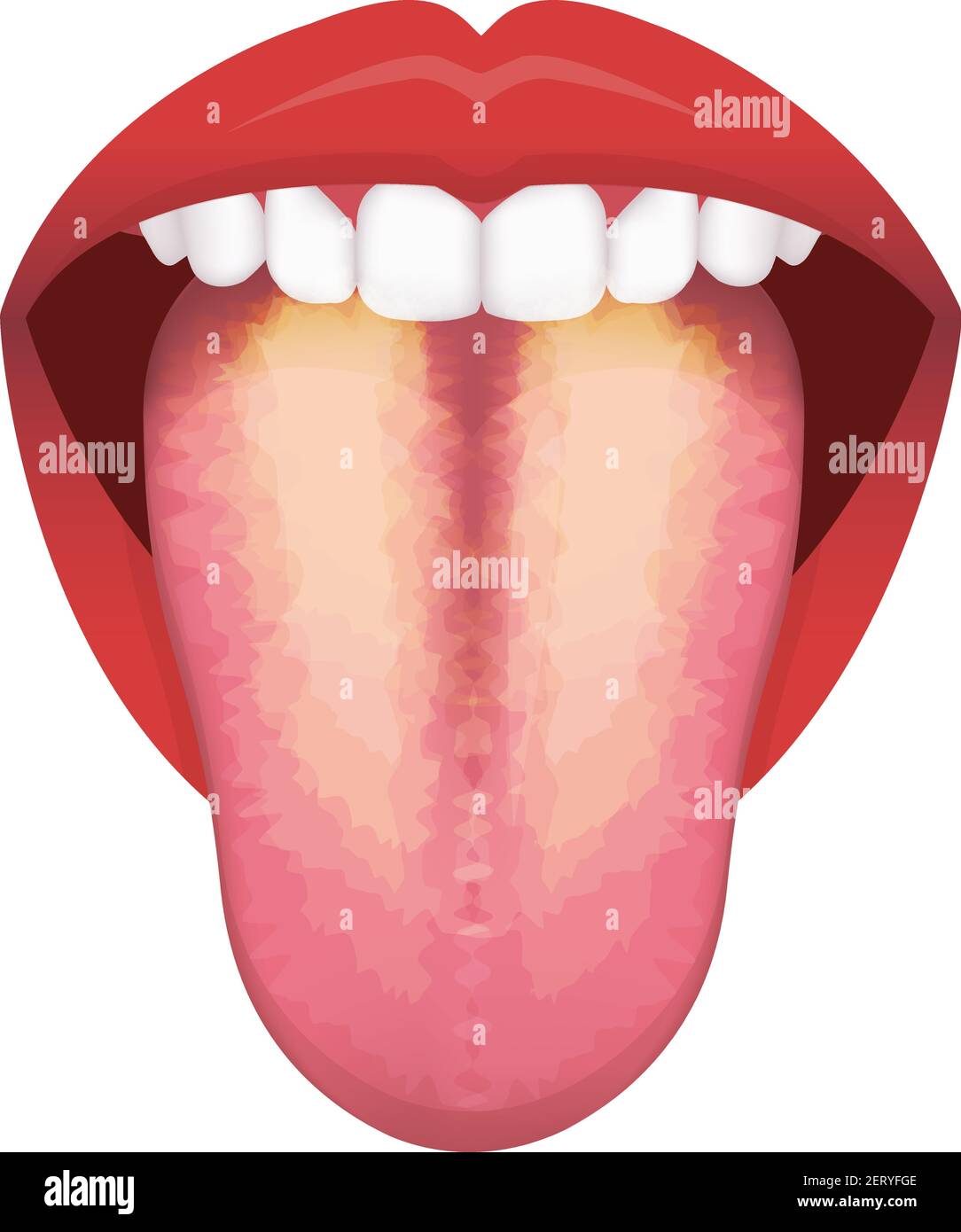 Zunge Gesundheit Zeichen Vektor-Illustration ( Gelbe beschichtete Zunge ) Stock Vektor