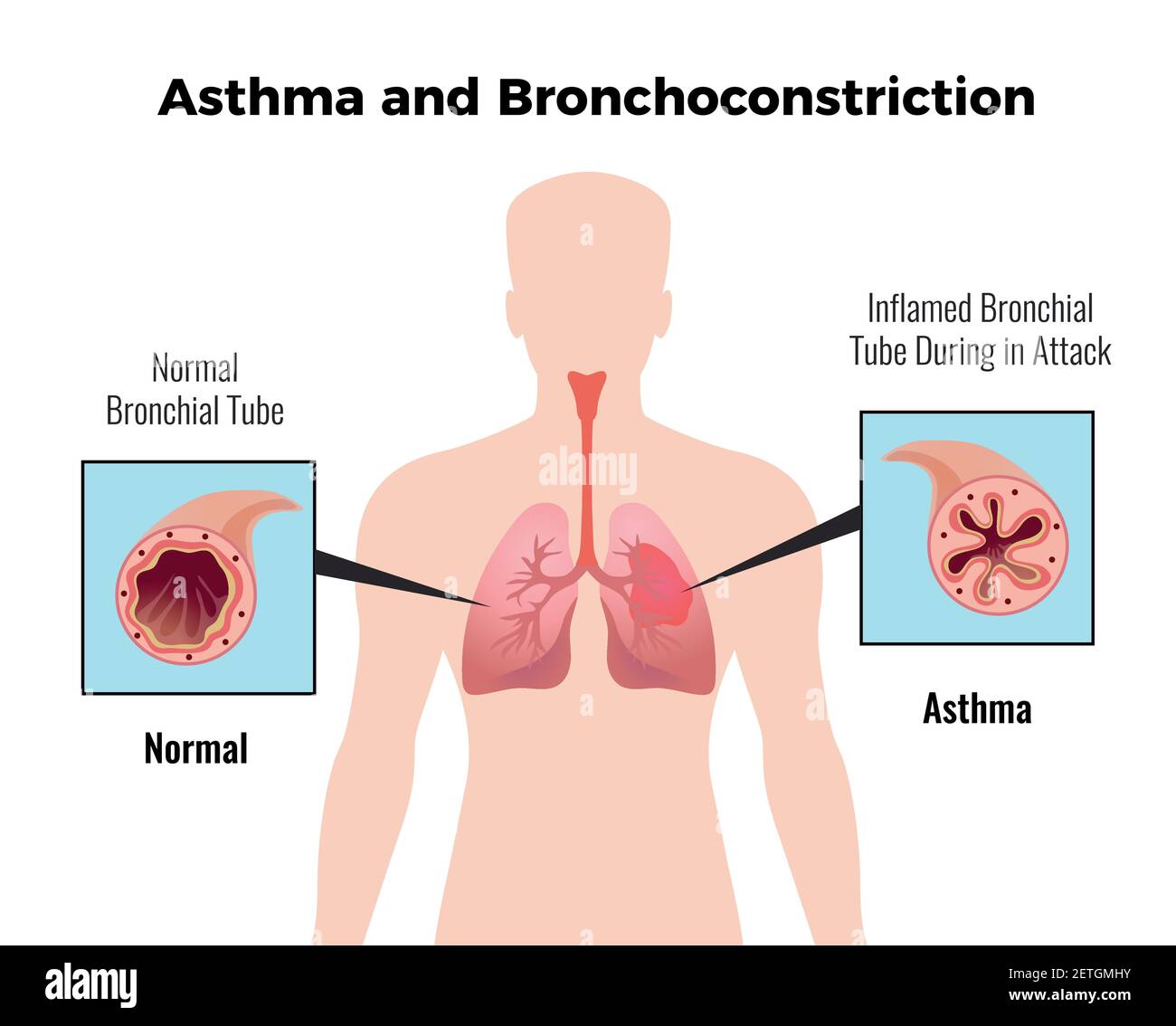 Asthma-Attacke medizinisches pädagogisches Chart-Poster mit Darstellung des Normalen Und entzündete Bronchialröhrchen flache Vektor-Illustration Stock Vektor