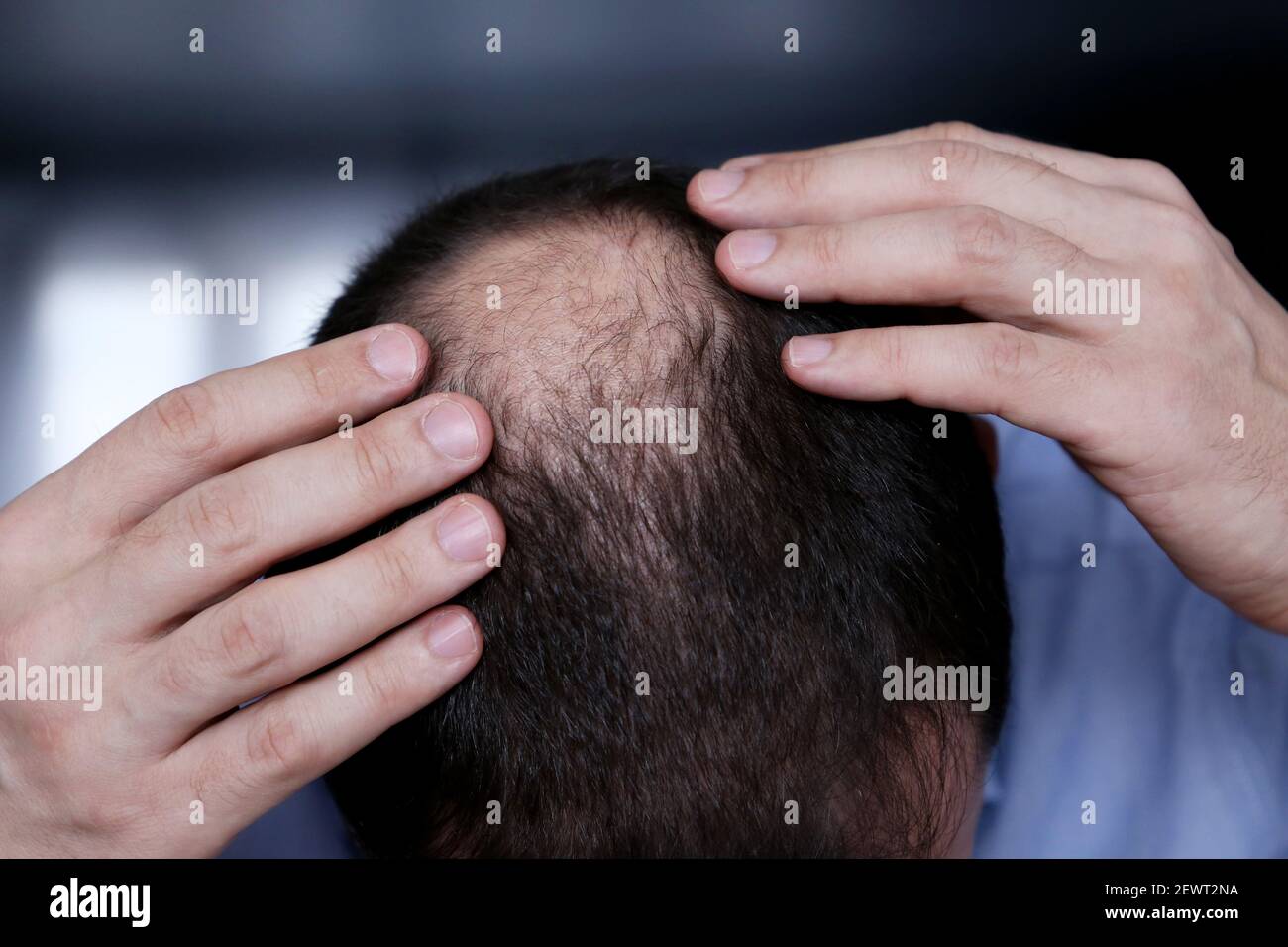 Kahlheit, Mann besorgt über Haarausfall. Männlicher Kopf mit einem kahlen, selektiven Fokus auf der Hand Stockfoto