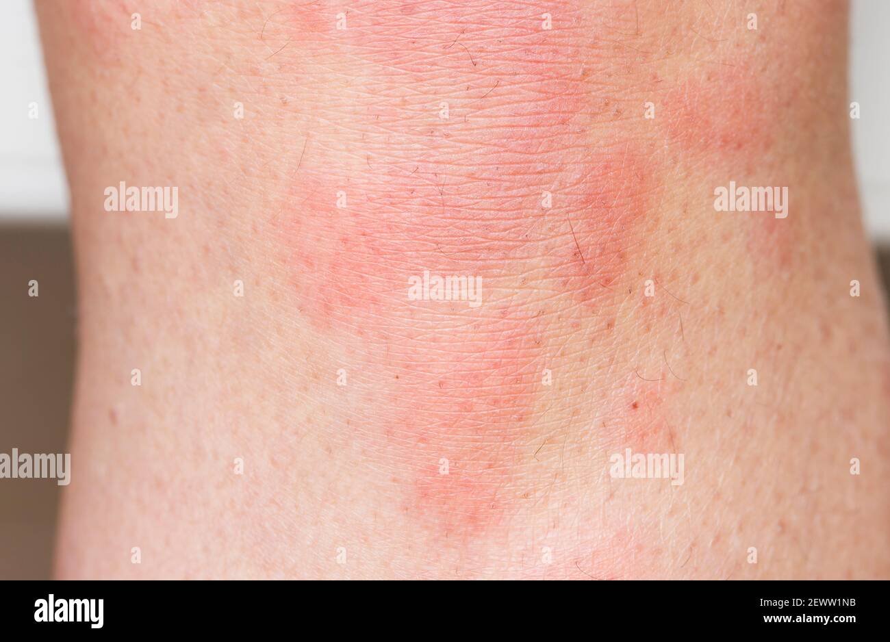 Nesselsucht auf der Haut, roter Urtikaria-Ausschlag am Körper einer Frau. Zeigt Hautallergien oder Hautinfektionen, Großbritannien Stockfoto