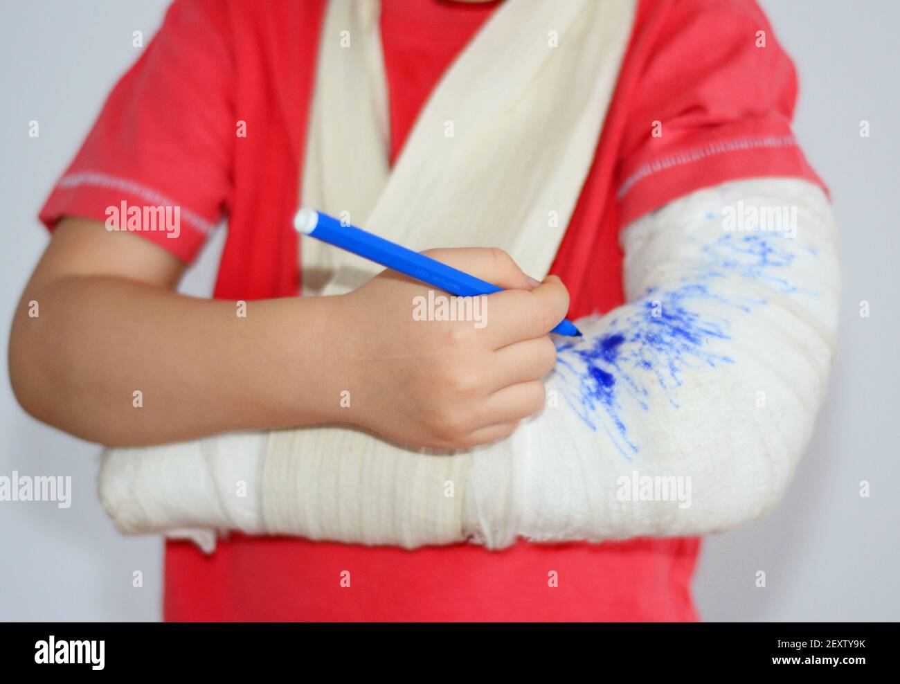 Ein Kind von vier Jahren trägt einen Guss, um die Bewegungen eines gebrochenen Armes einzuschränken, zeichnet auf den Guss, wodurch der Verband bunt wird. Stockfoto