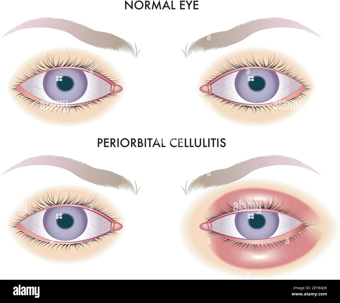 Die medizinische Illustration zeigt den Vergleich zwischen normalen Augen und den von periorbitaler Cellulitis betroffenen Augen. Stock Vektor