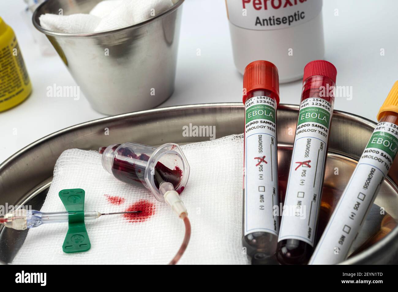 Blutprobe von Ebola-Patienten, positives Ergebnis, konzeptuelles Bild Stockfoto