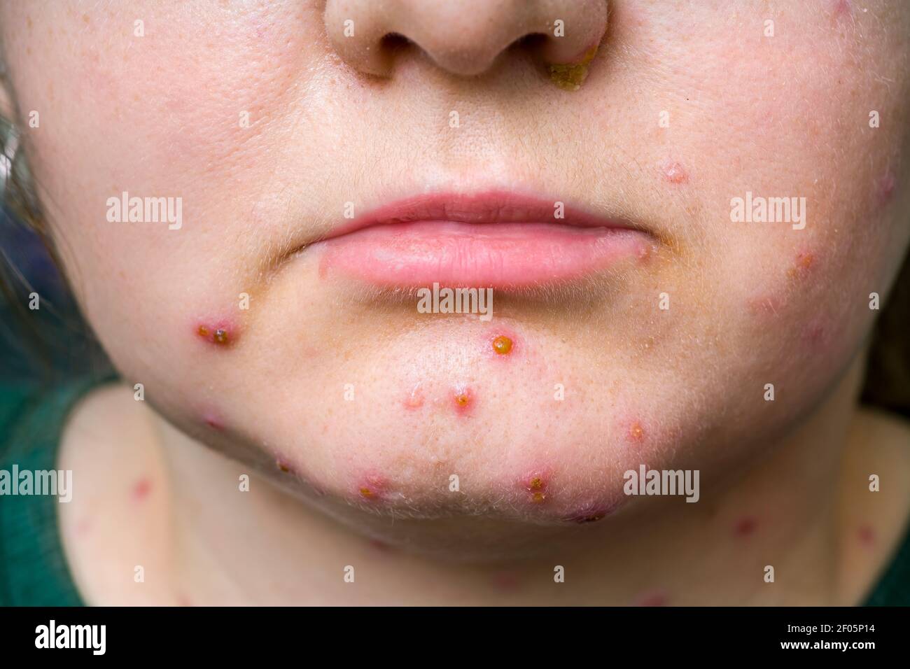 Pocken Infektion Stockfotos Und Bilder Kaufen Alamy
