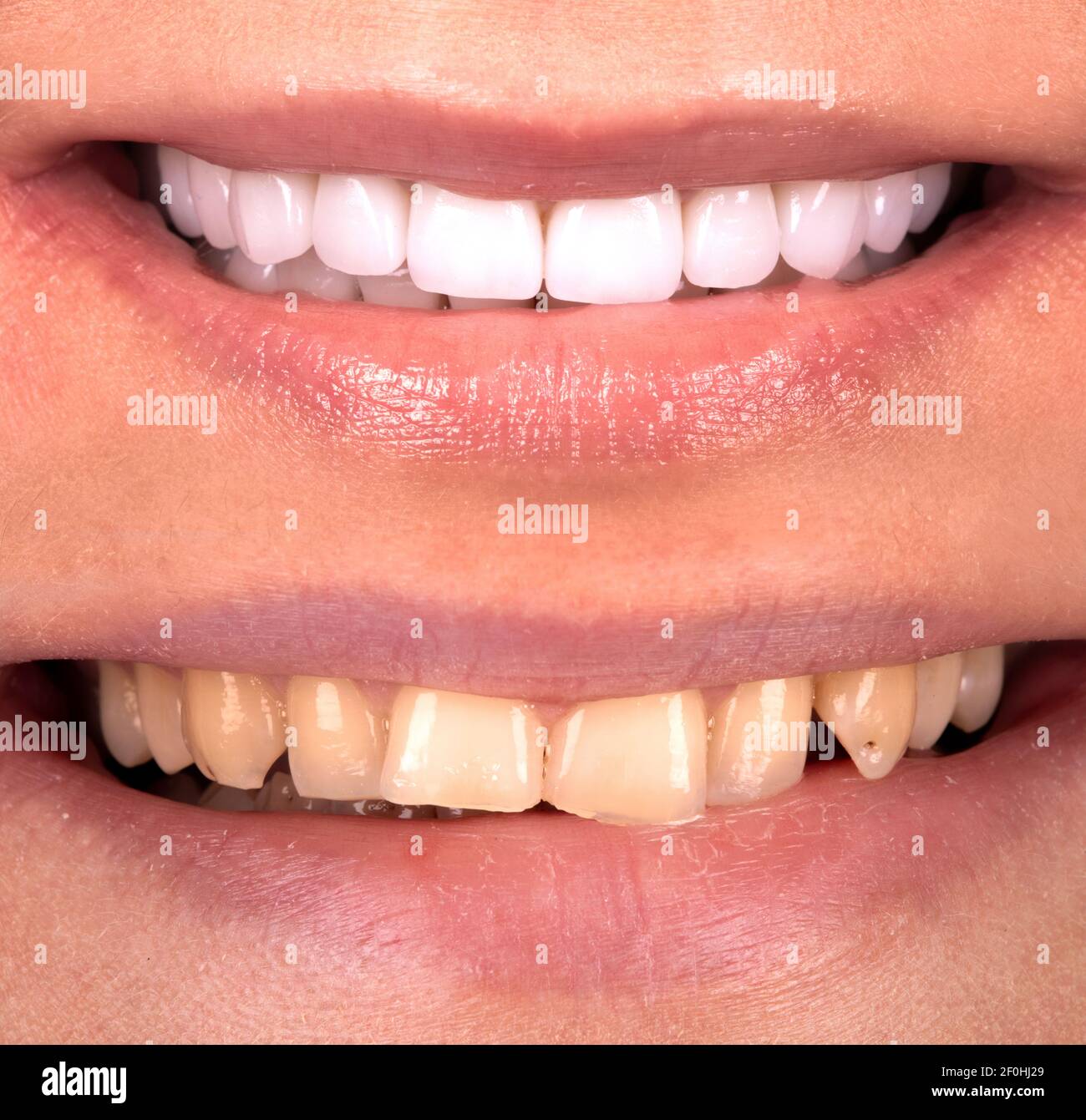 Perfektes Lächeln vor und nach Bleaching Verfahren Bleaching von Zirkonbogen keramische Prothesen Implantate Kronen. Zahnärztliche Restaurierung Behandlung Klinik Pat Stockfoto