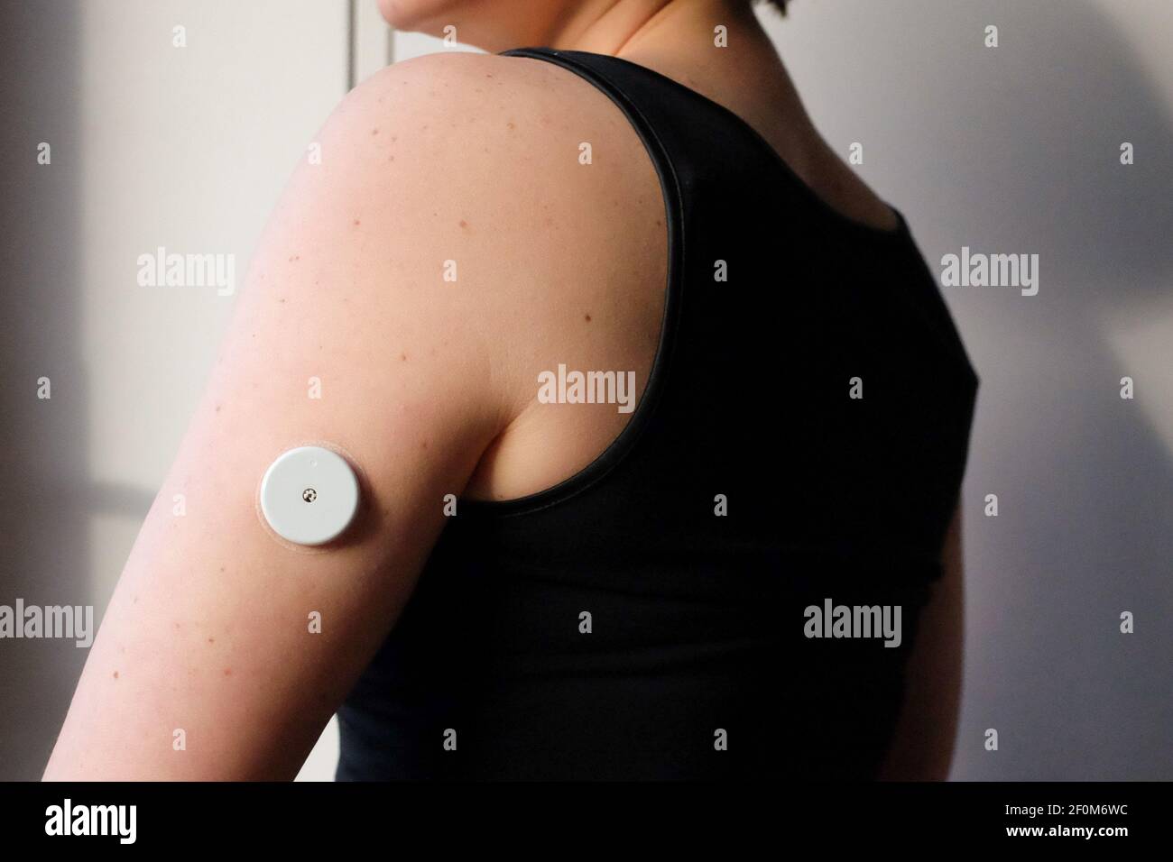 Eine Frau trägt einen Freestyle Libre Flash Glukosesensor. Das Gerät, das  normalerweise am Oberarm getragen wird, hilft Menschen mit Typ-1-Diabetes,  ihren Blutzuckerspiegel zu überwachen. Jeder Sensor hält 14 Tage und kostet  etwa £