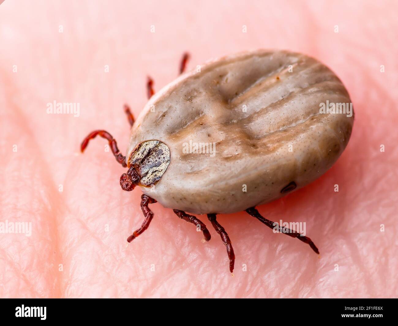 Enzephalitis Virus oder Lyme-Borreliose Infektiöse Dermacentor Ixodid Tick Parasit Insect on Skin Makro Stockfoto
