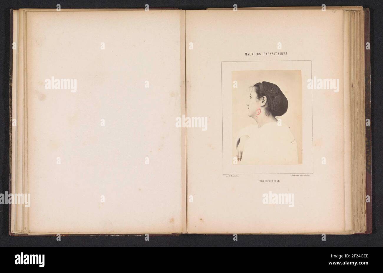 Frau in Ringwurm in ihrem Hals engagiert; Herpès circiné .. Stockfoto