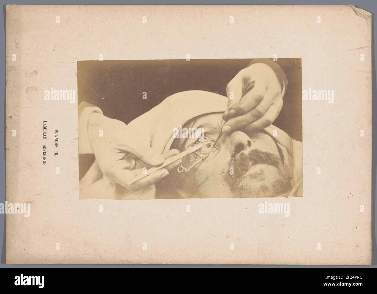 Operation auf die höchste Augenklappe; Lambeau Supérieur .. Stockfoto