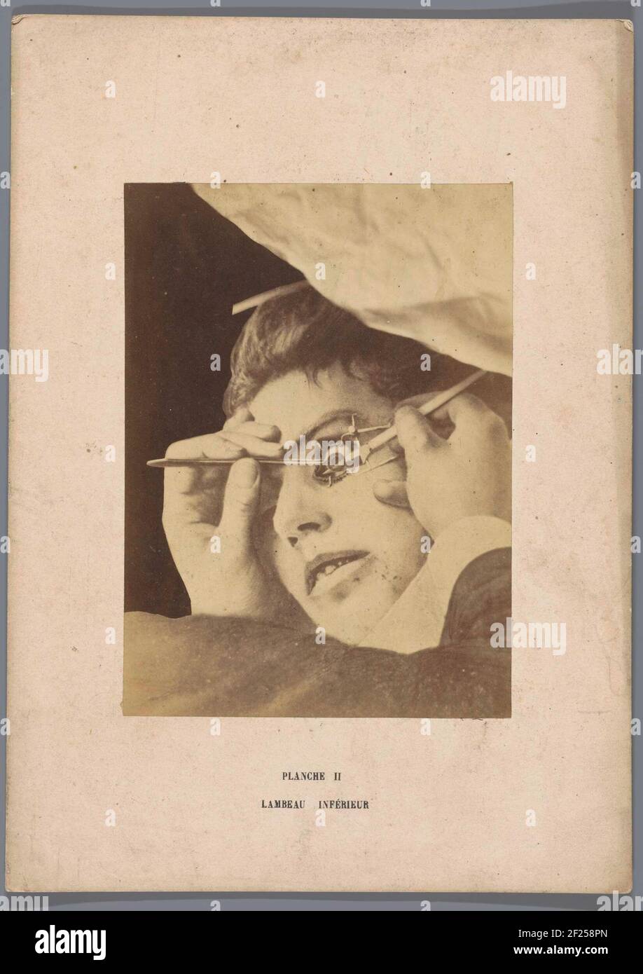 Operation an der unteren Augenklappe; Lambeau Inférieur .. Stockfoto