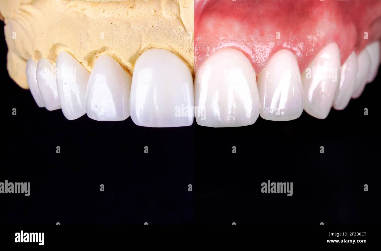 Perfektes Lächeln vor und nach Veneers Bleichmittel von Zirkon Bogen Keramik Prothesen Implantate Kronen. Zahnwiederherstellung Behandlung Klinik Patient. Ergebnis von Stockfoto