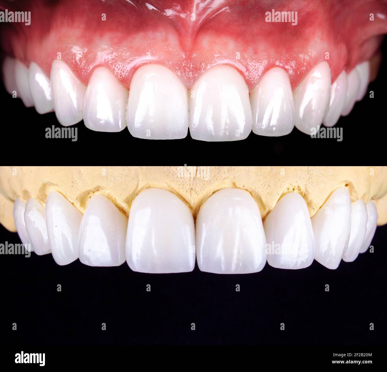 Perfektes Lächeln vor und nach Veneers Bleichmittel von Zirkon Bogen Keramik Prothesen Implantate Kronen. Zahnwiederherstellung Behandlung Klinik Patient. Ergebnis von Stockfoto