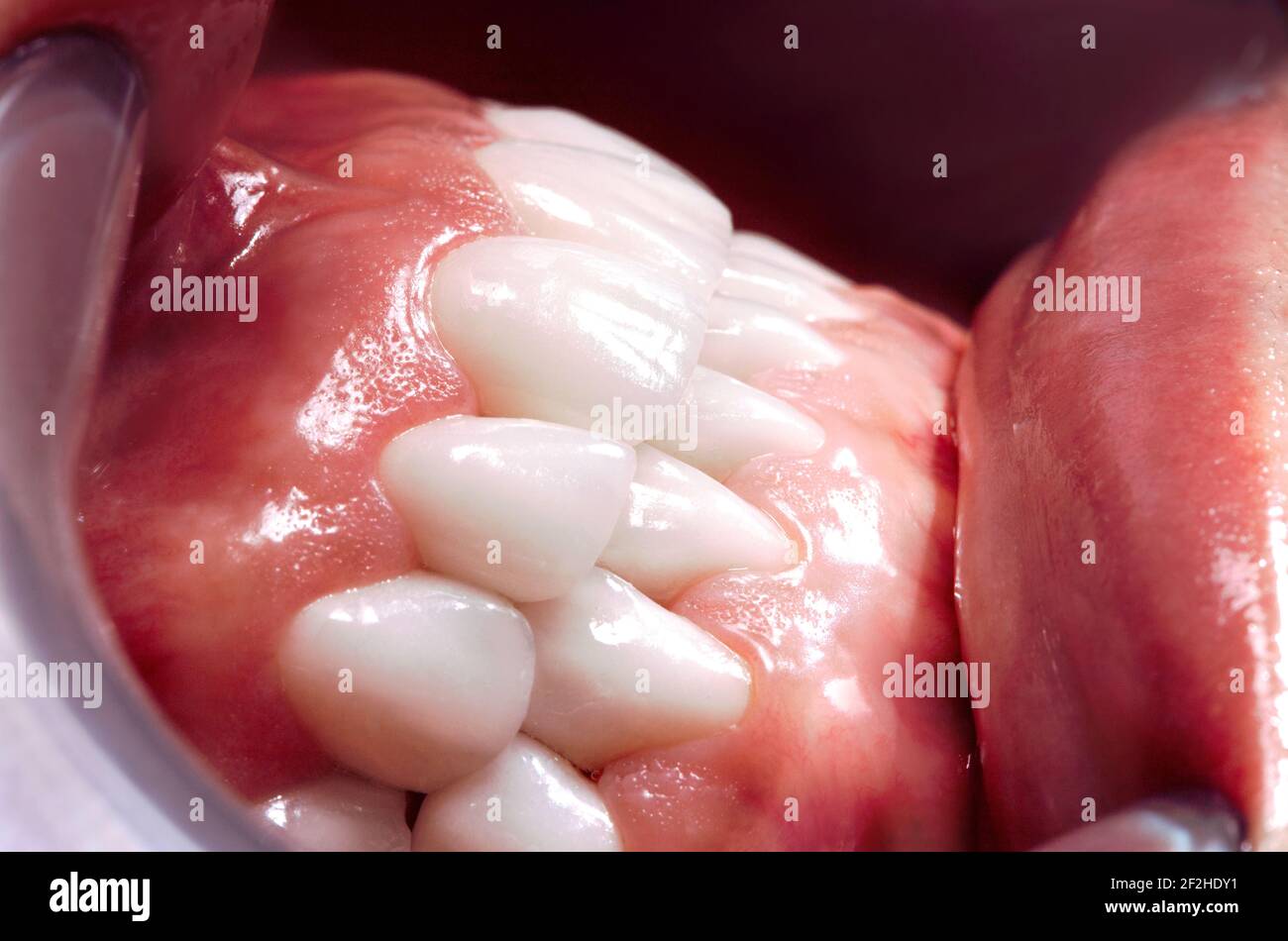 Perfekte Lächeln Chirurgie Veneers Bleichmittel von Zirkonbogen keramische Prothesen Implantate Kronen. Zahnwiederherstellung Behandlung Klinik Patient. Ergebnis der oralen Pro Stockfoto