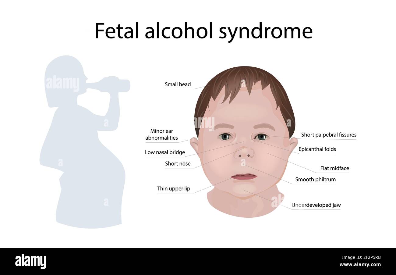 Fetales Alkoholsyndrom, Illustration Stockfoto