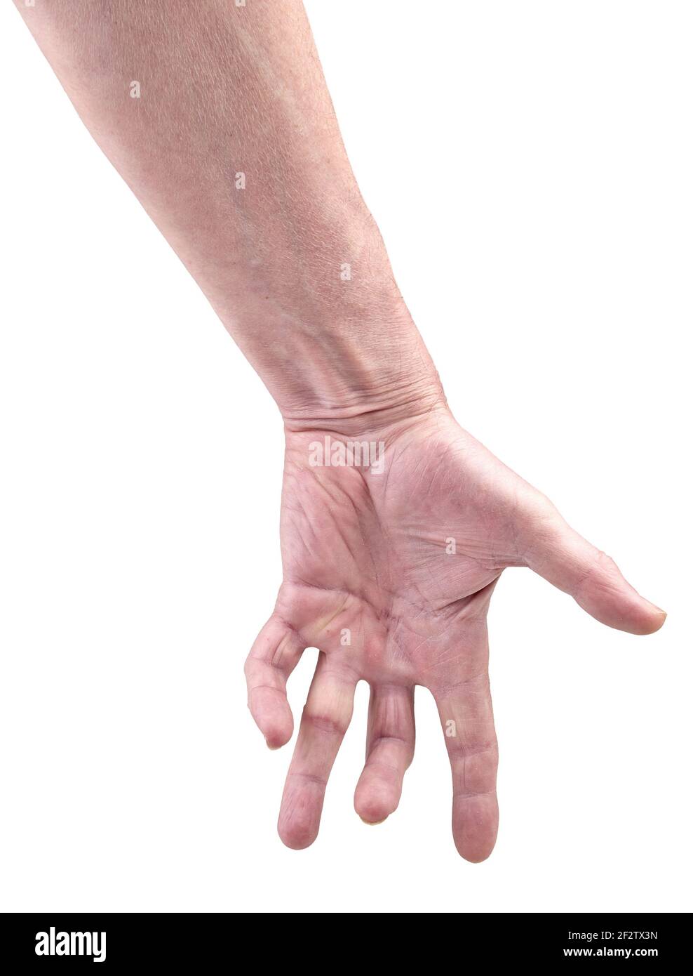 Hand eines Mannes mit Dupuytren Kontrakturkrankheit, isoliert auf weißem Hintergrund Stockfoto