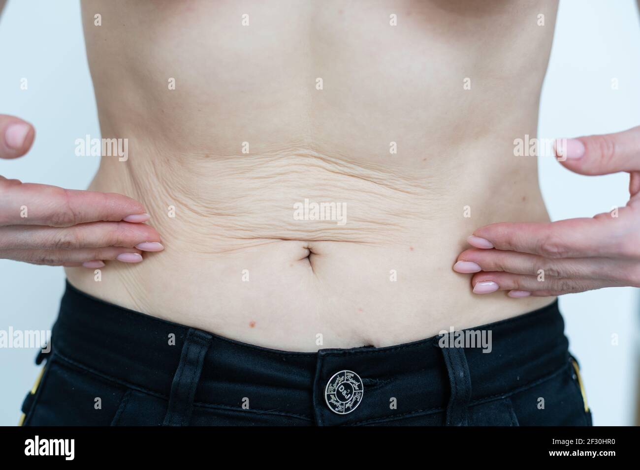 Nahaufnahme einer Frau, die auf ihrem Bauch mit schlaffe Haut zeigt. Gesundheitskonzept. Stockfoto