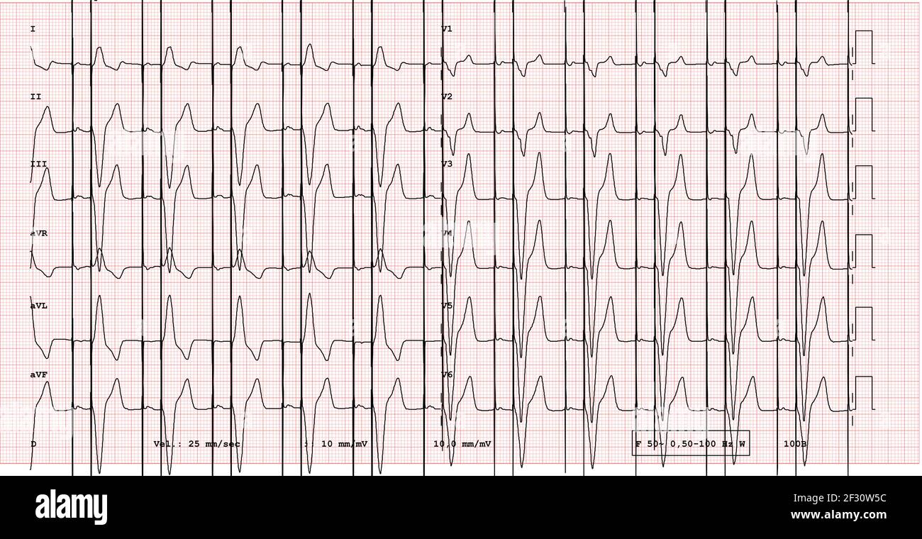 EKG-Beispiel für einen Schrittmacher-Rhythmus mit 12 Ableitungen und Schrittmacherspitze Stockfoto