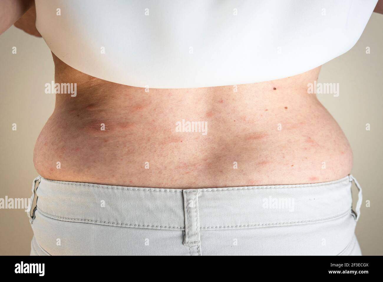 Frauen mit Symptomen von juckender Urtikaria oder allergischer Reaktion