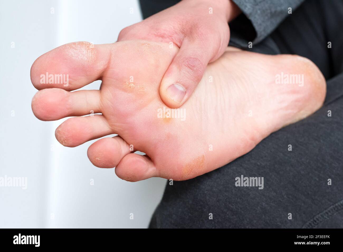 Fuß mit Hühneraugen, Schwielen und trockener Haut, Warze plantar ...