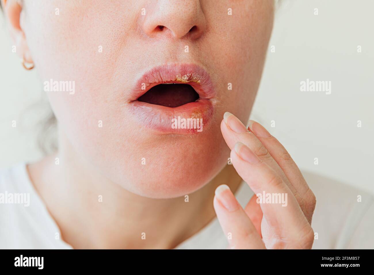 Nahaufnahme von Mädchen Lippen von Herpes betroffen. Behandlung von Herpes-Infektion und Virus. Teil der jungen Frau Gesicht mit Finger berühren Schmerzen auf den Lippen mit ihr Stockfoto