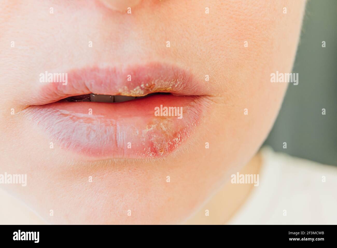 Nahaufnahme von Mädchen Lippen von Herpes betroffen. Behandlung von Herpes-Infektion und Virus. Teil der jungen Frau Gesicht, Lippen mit Herpes betroffen. Beauty Dermato Stockfoto