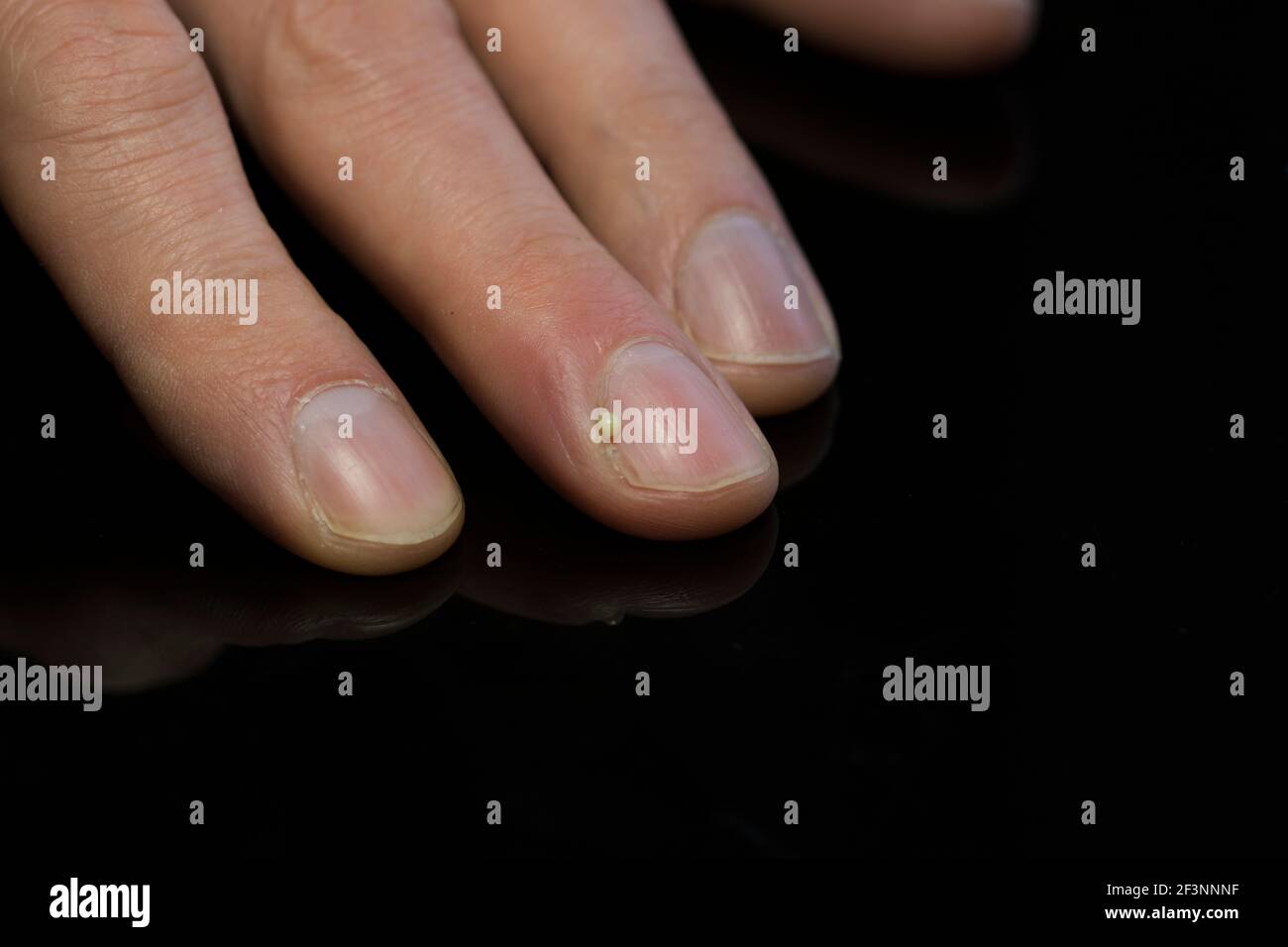 Nahaufnahme Finger Nagel Infektion mit Eiter ausgegossen. Gesundheit und Wohlbefinden der Hände. Stockfoto