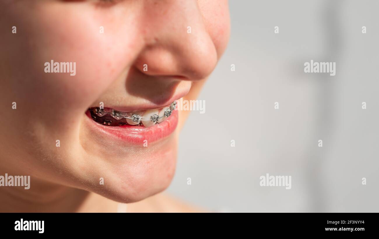 Nahaufnahme eines Teenagers, das in kieferorthopädischen Klammern lächelt. Mädchen mit Zahnspangen. Kieferorthopädische Behandlung. Stockfoto