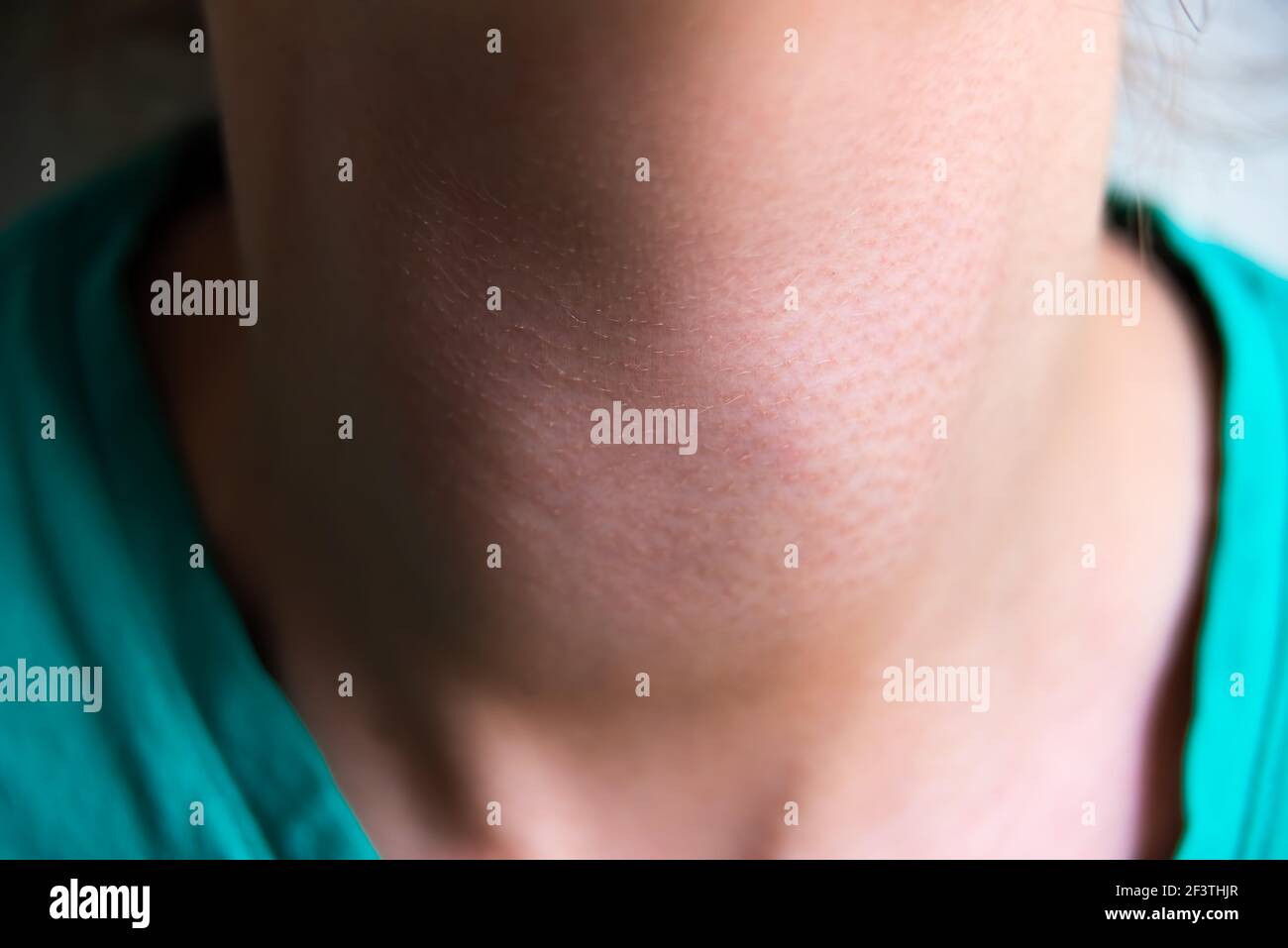 Makroaufnahme von jungen Frau Hals mit Grave-Krankheit Hyperthyreose Symptome einer vergrößerten Schilddrüse Kropf Stockfoto