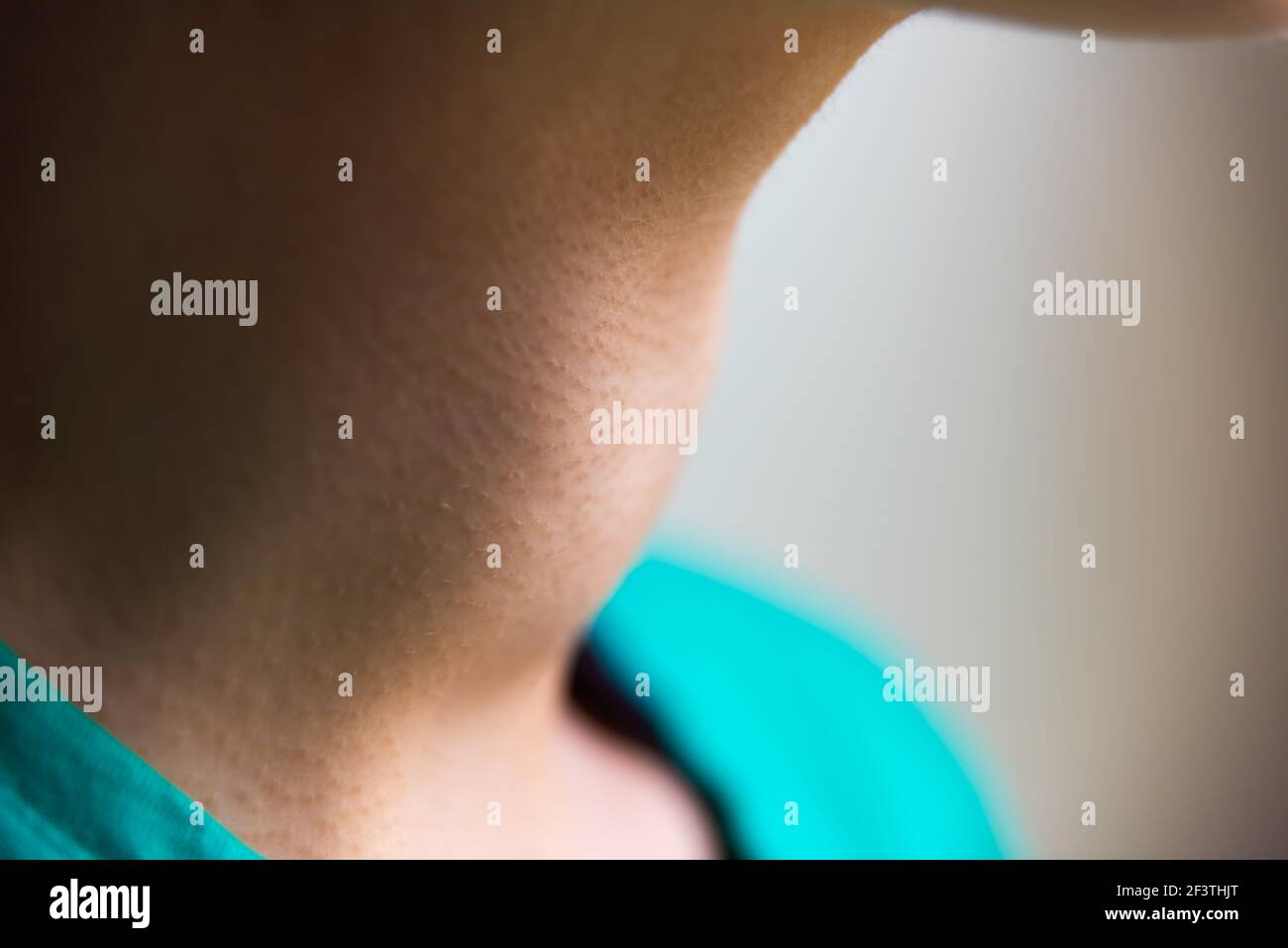 Makro Nahaufnahme Porträt der jungen Frau Hals-Profil mit Gravis Krankheit Hyperthyreose Symptome einer vergrößerten Schilddrüsenkropf Stockfoto