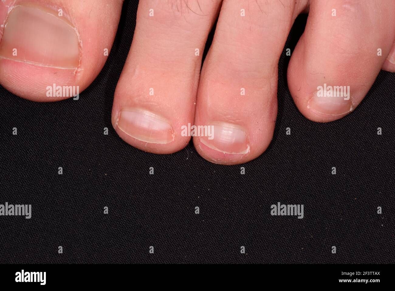 Weisse zehennägel