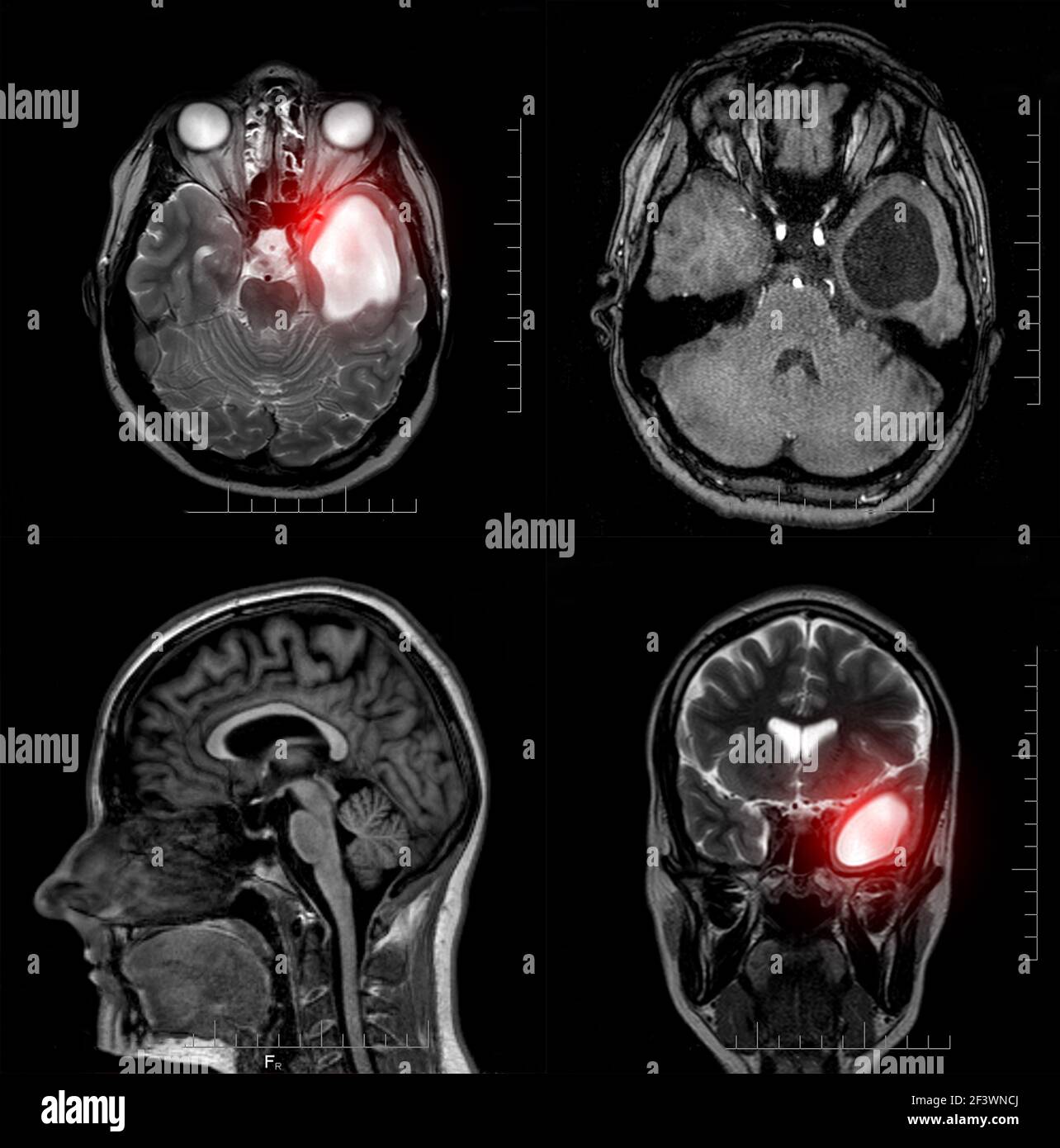 Magnetresonanztomographie eines Patienten mit einer temporalen Hornzyste des linken lateralen Ventrikels des Gehirns. Atrophische Veränderungen im Temporallappen. A Stockfoto