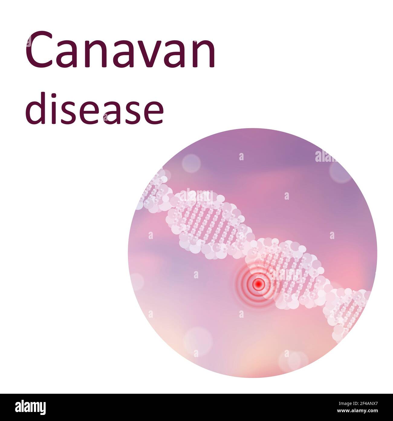 Canavan-Krankheit, Illustration Stockfoto