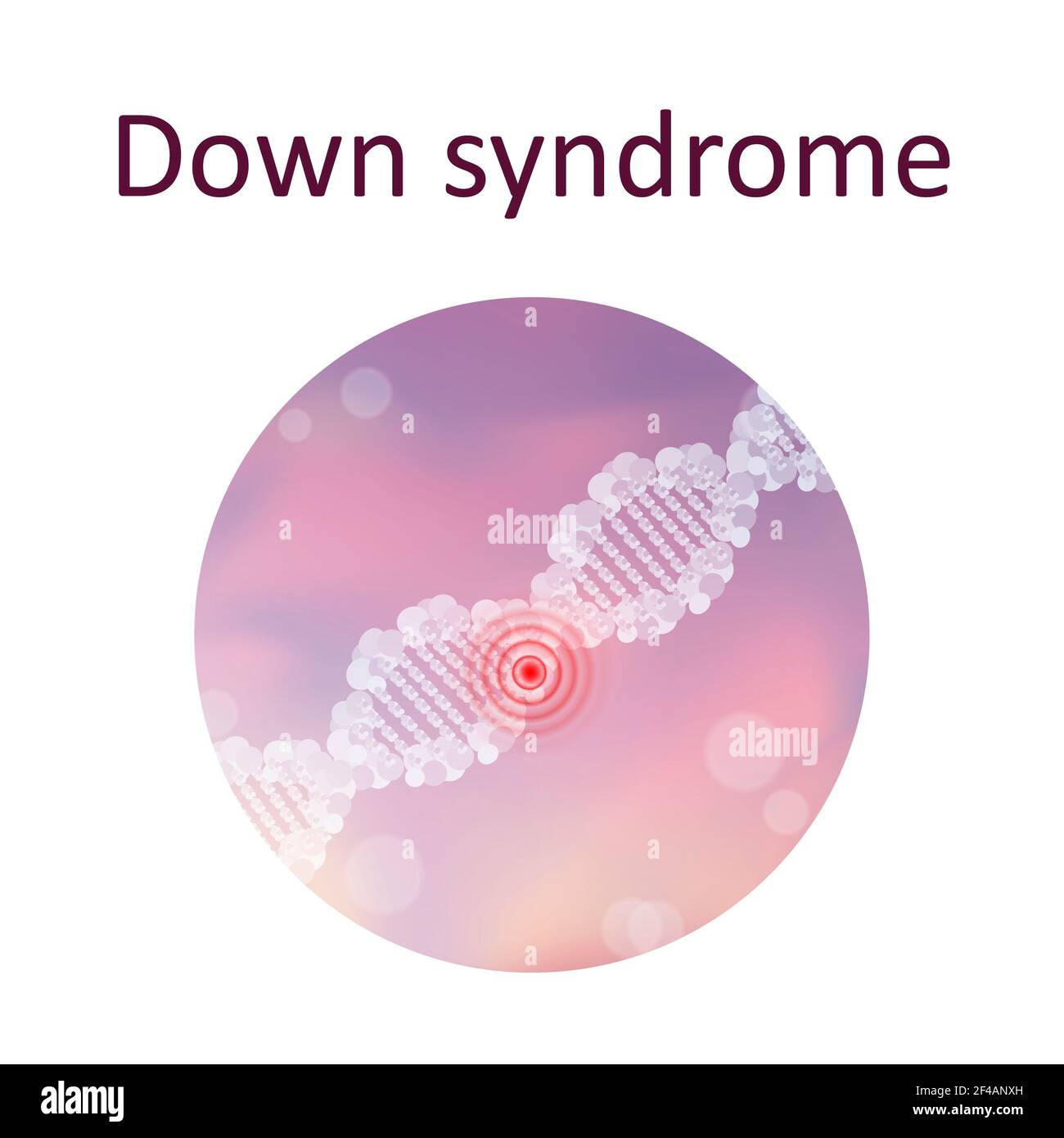 Down-Syndrom, Illustration Stockfoto