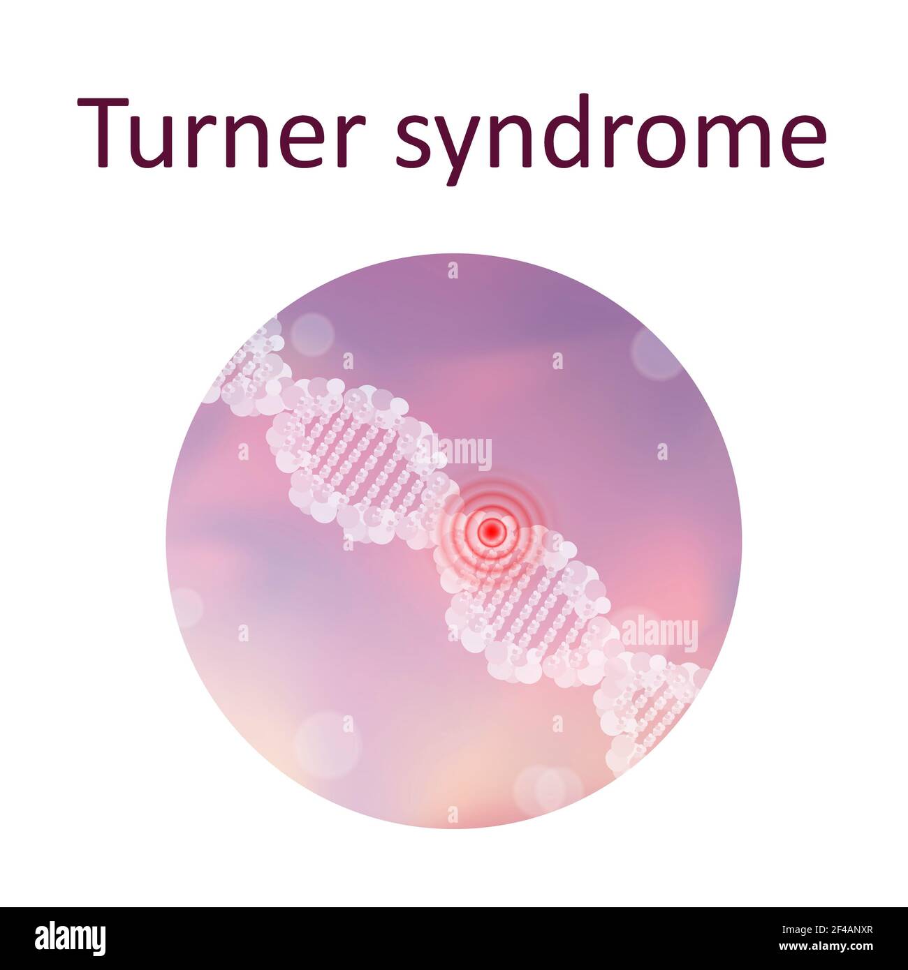 Turner-Syndrom, Illustration Stockfoto