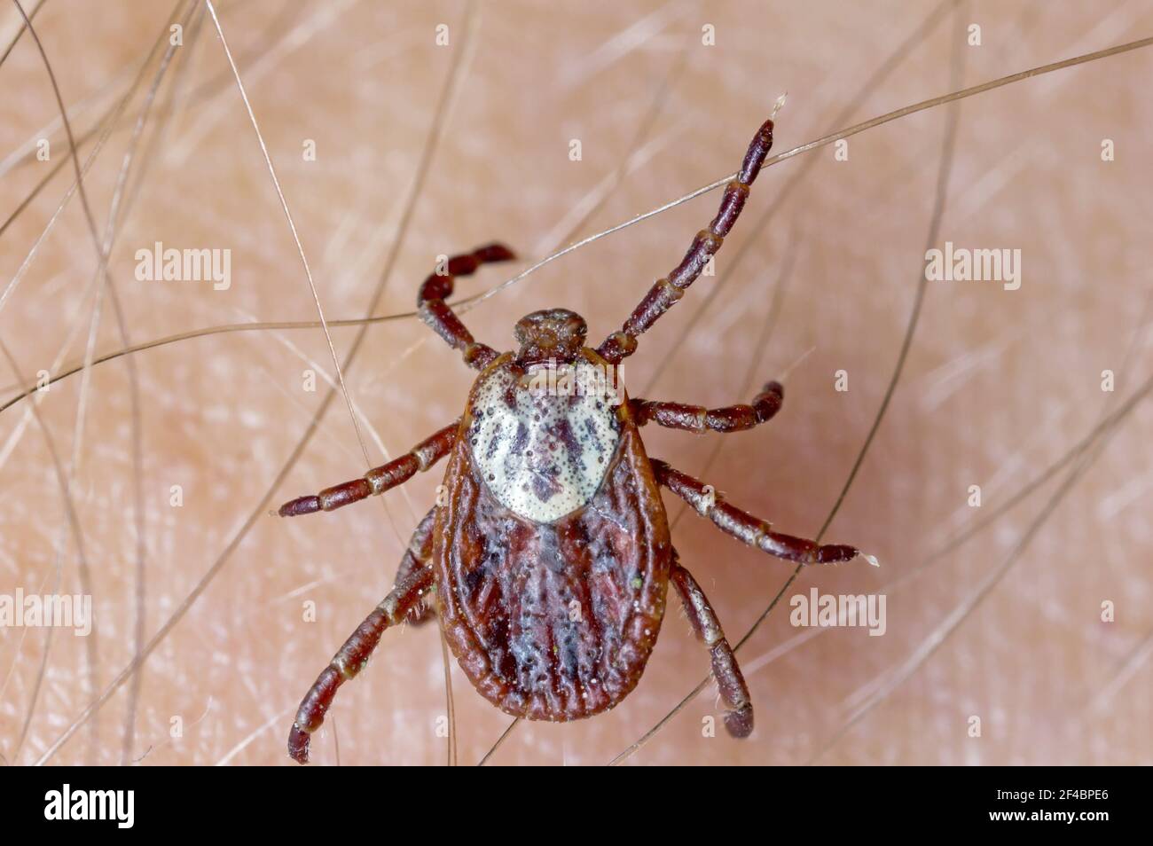 Lyme-Borreliose-Träger Ixodes Zecken Dermacentor marginatus auf der menschlichen Haut. Stockfoto